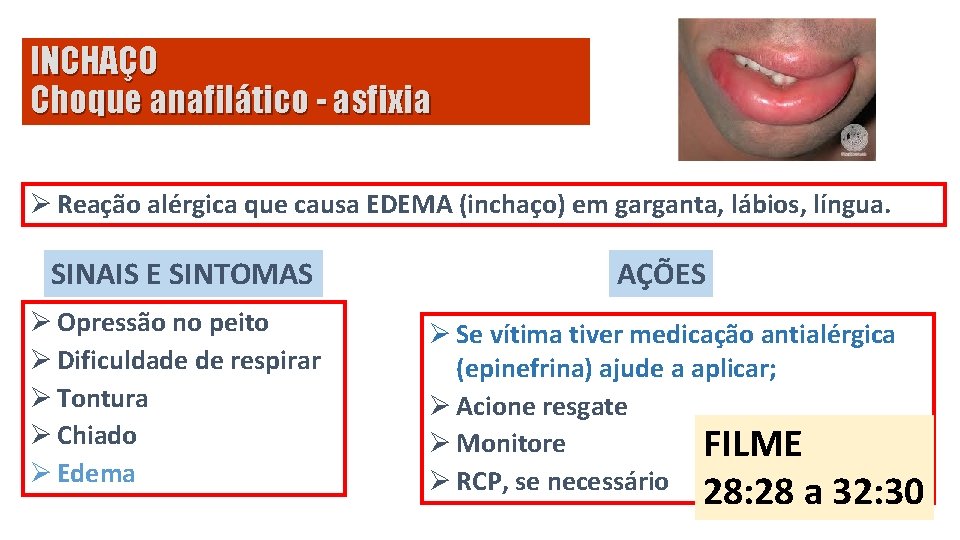 INCHAÇO Choque anafilático - asfixia Ø Reação alérgica que causa EDEMA (inchaço) em garganta,