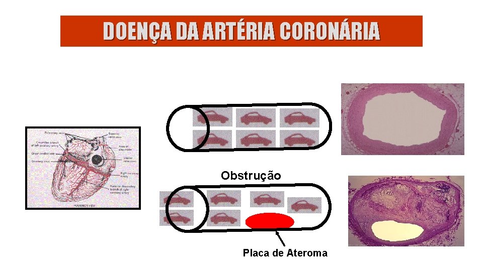 DOENÇA DA ARTÉRIA CORONÁRIA Obstrução Placa de Ateroma 