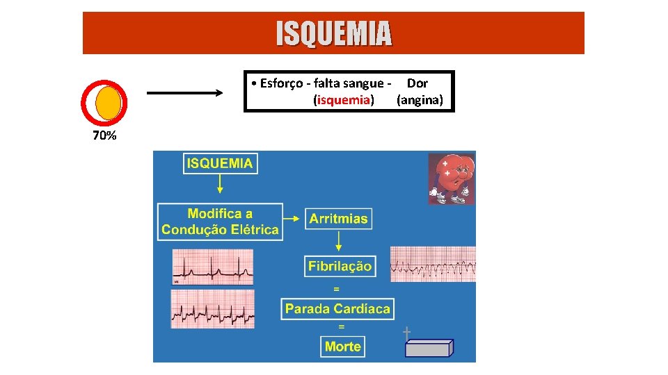 ISQUEMIA • Esforço - falta sangue - Dor (isquemia) (angina) 70% 