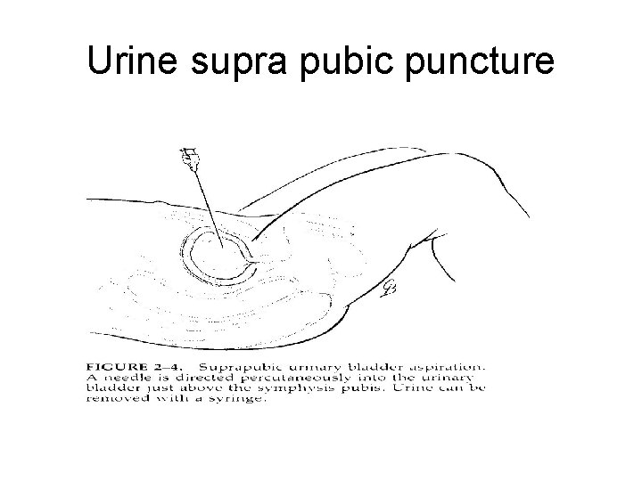 Urine supra pubic puncture 