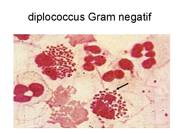 diplococcus Gram negatif 