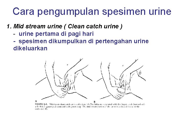 Cara pengumpulan spesimen urine 1. Mid stream urine ( Clean catch urine ) -