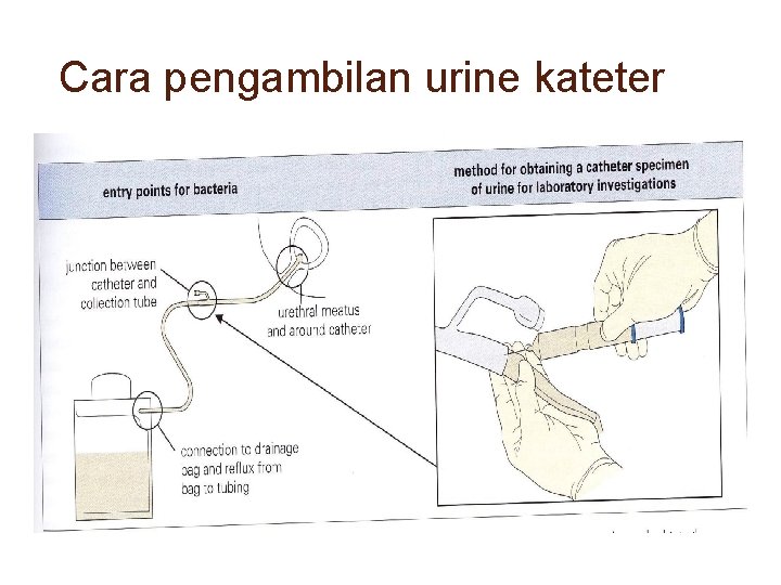 Cara pengambilan urine kateter 