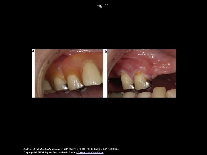 Fig. 11 Journal of Prosthodontic Research 2014 5871 -84 DOI: (10. 1016/j. jpor. 2014.