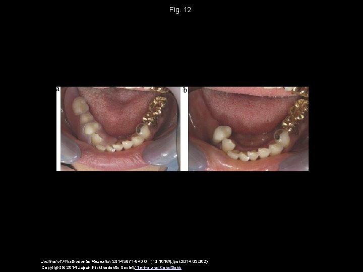 Fig. 12 Journal of Prosthodontic Research 2014 5871 -84 DOI: (10. 1016/j. jpor. 2014.