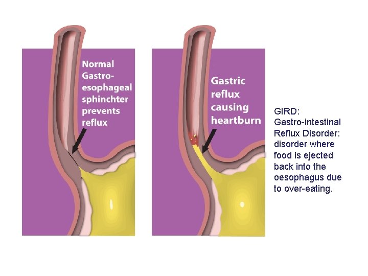 GIRD: Gastro-intestinal Reflux Disorder: disorder where food is ejected back into the oesophagus due