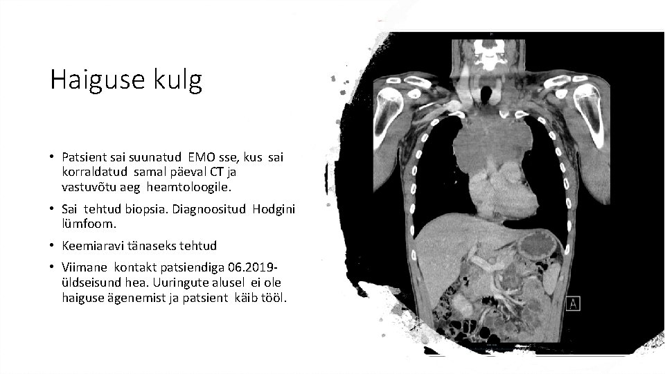 Haiguse kulg • Patsient sai suunatud EMO sse, kus sai korraldatud samal päeval CT