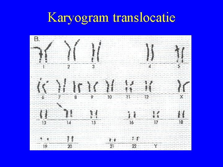 Karyogram translocatie 