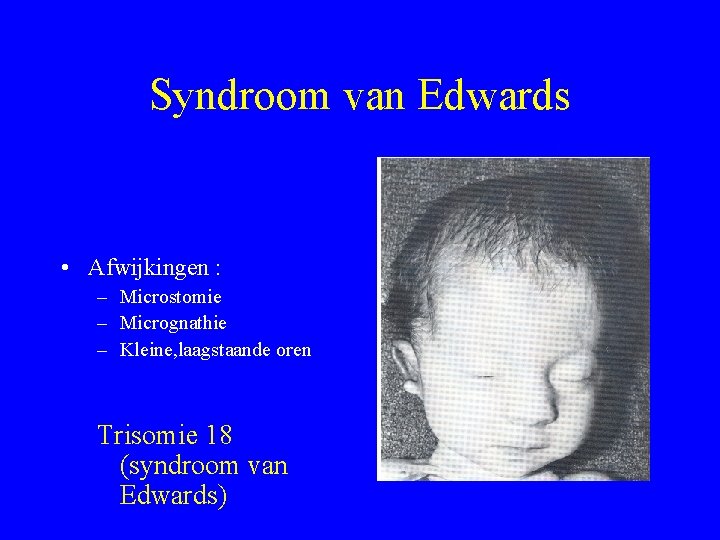 Syndroom van Edwards • Afwijkingen : – Microstomie – Micrognathie – Kleine, laagstaande oren
