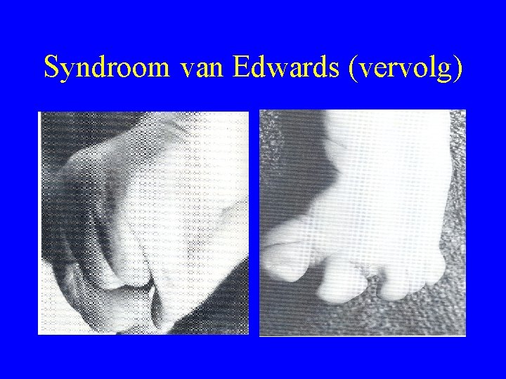 Syndroom van Edwards (vervolg) 