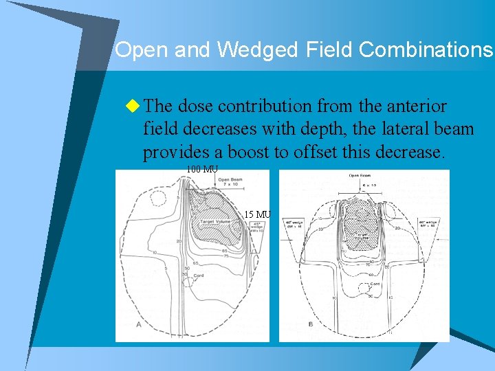 Open and Wedged Field Combinations u The dose contribution from the anterior field decreases