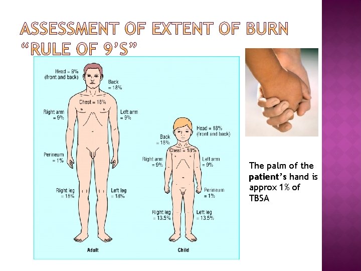 The palm of the patient’s hand is approx 1% of TBSA 