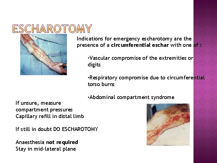 Indications for emergency escharotomy are the presence of a circumferential eschar with one of