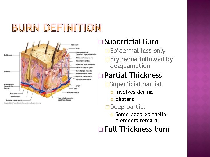 � Superficial Burn �Epidermal loss only �Erythema followed by desquamation � Partial Thickness �Superficial