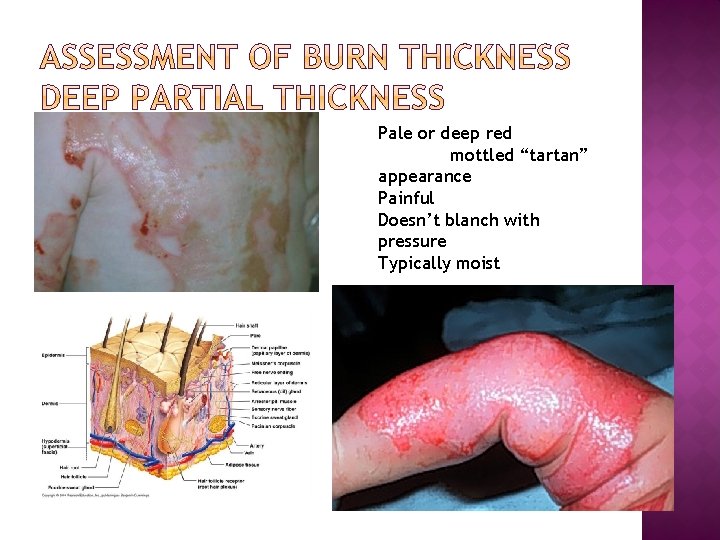 Pale or deep red mottled “tartan” appearance Painful Doesn’t blanch with pressure Typically moist