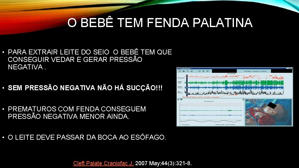 O BEBÊ TEM FENDA PALATINA • PARA EXTRAIR LEITE DO SEIO O BEBÊ TEM