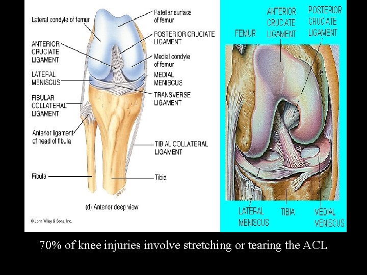 70% of knee injuries involve stretching or tearing the ACL 