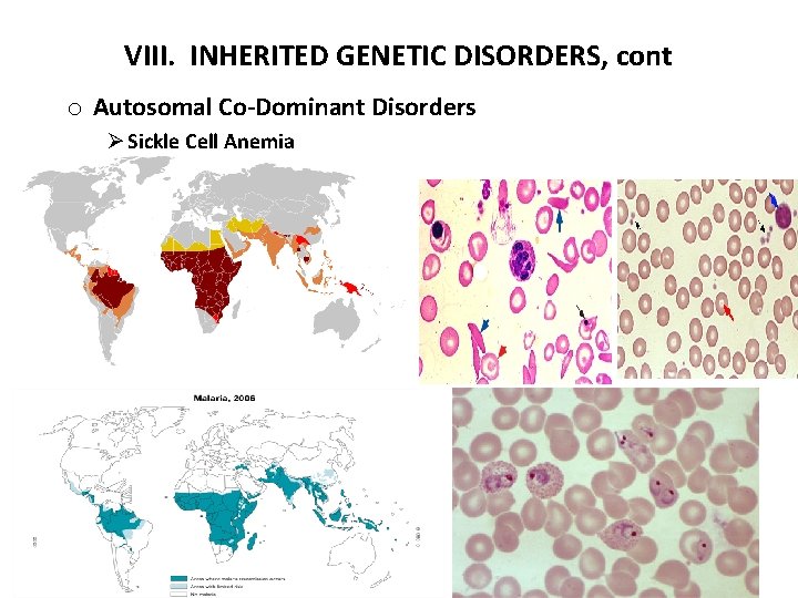 VIII. INHERITED GENETIC DISORDERS, cont o Autosomal Co-Dominant Disorders Ø Sickle Cell Anemia 