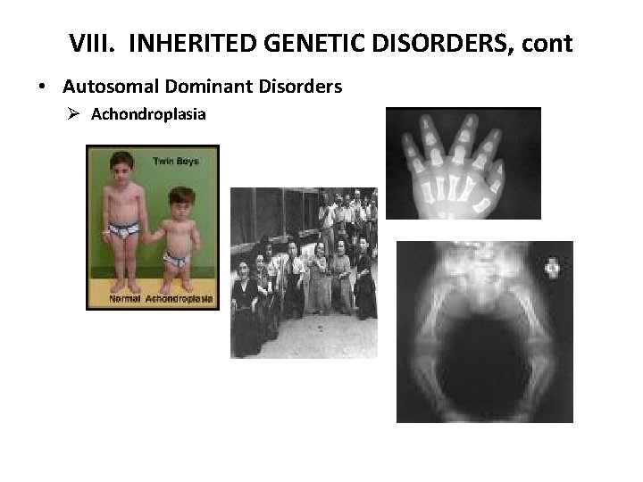 VIII. INHERITED GENETIC DISORDERS, cont • Autosomal Dominant Disorders Ø Achondroplasia 