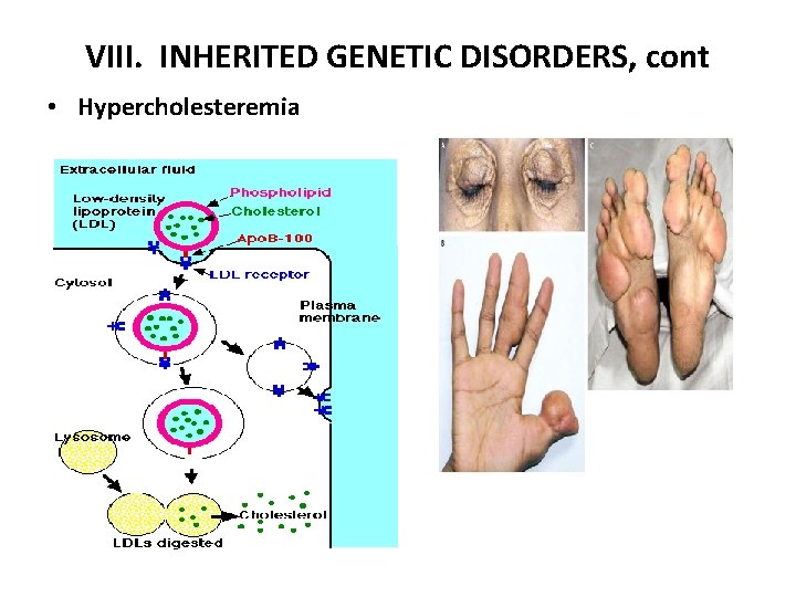 VIII. INHERITED GENETIC DISORDERS, cont • Hypercholesteremia 