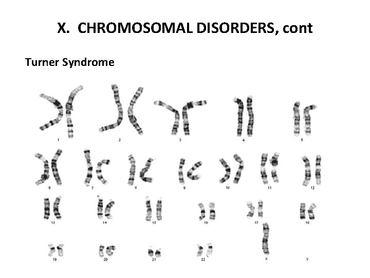 X. CHROMOSOMAL DISORDERS, cont Turner Syndrome 