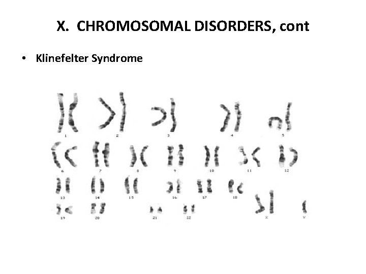 X. CHROMOSOMAL DISORDERS, cont • Klinefelter Syndrome 