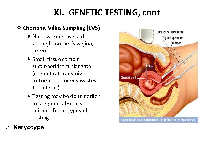 XI. GENETIC TESTING, cont v Chorionic Villus Sampling (CVS) Ø Narrow tube inserted through
