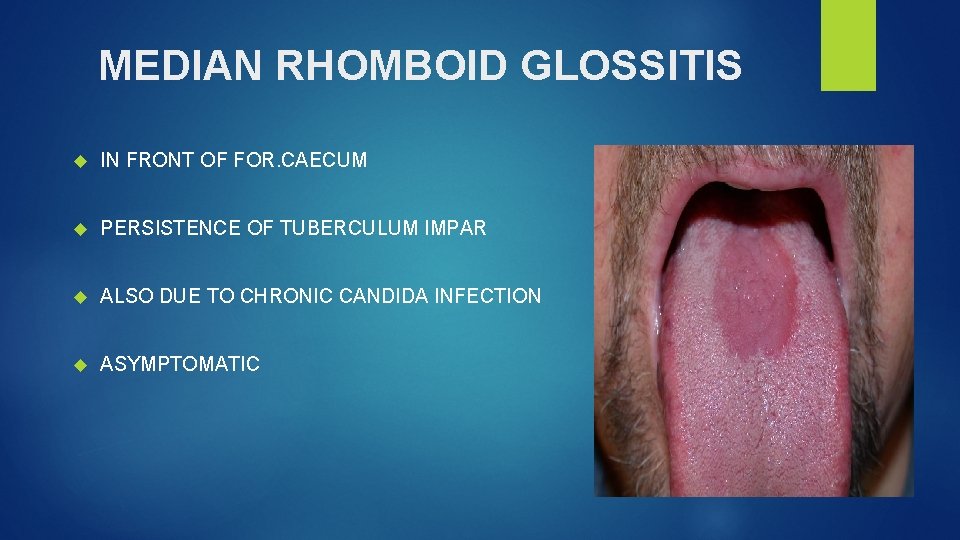 MEDIAN RHOMBOID GLOSSITIS IN FRONT OF FOR. CAECUM PERSISTENCE OF TUBERCULUM IMPAR ALSO DUE