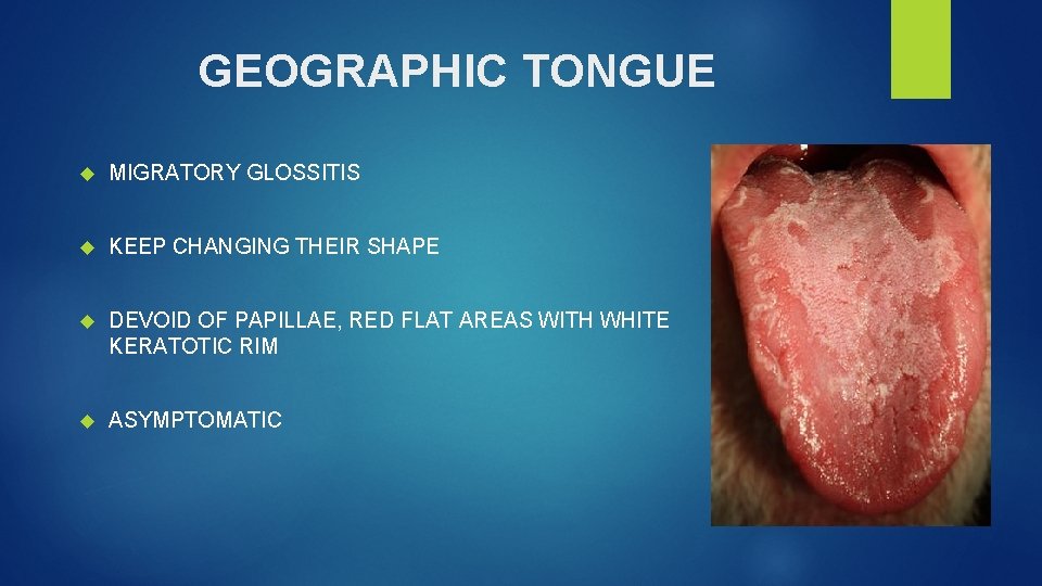 GEOGRAPHIC TONGUE MIGRATORY GLOSSITIS KEEP CHANGING THEIR SHAPE DEVOID OF PAPILLAE, RED FLAT AREAS