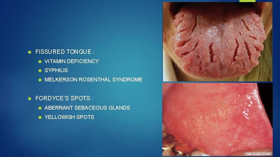  FISSURED TONGUE : VITAMIN DEFICIENCY SYPHILIS MELKERSON ROSENTHAL SYNDROME FORDYCE’S SPOTS : ABERRANT