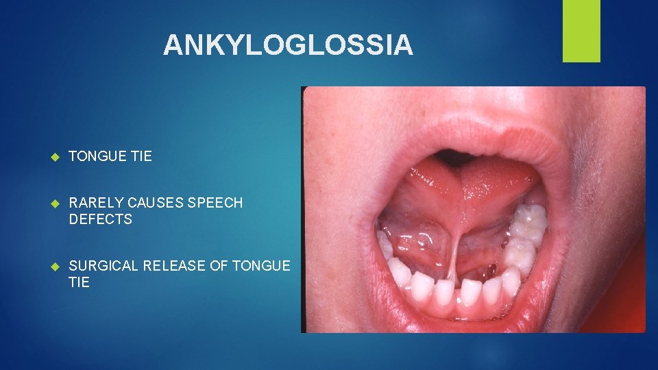 ANKYLOGLOSSIA TONGUE TIE RARELY CAUSES SPEECH DEFECTS SURGICAL RELEASE OF TONGUE TIE 