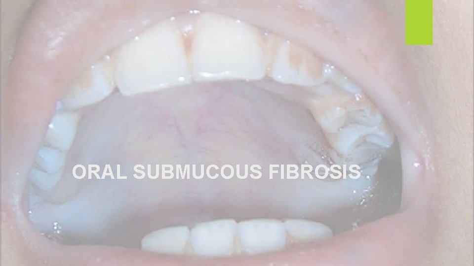 ORAL SUBMUCOUS FIBROSIS 