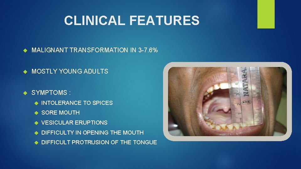 CLINICAL FEATURES MALIGNANT TRANSFORMATION IN 3 -7. 6% MOSTLY YOUNG ADULTS SYMPTOMS : INTOLERANCE