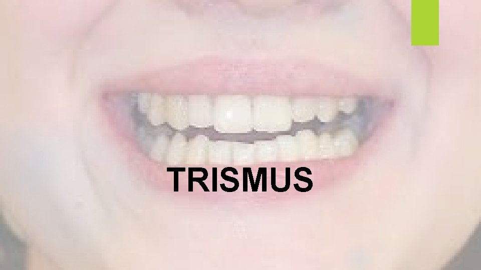 TRISMUS 