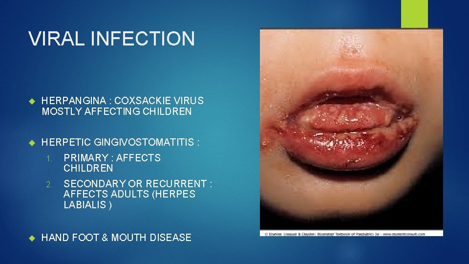 VIRAL INFECTION HERPANGINA : COXSACKIE VIRUS MOSTLY AFFECTING CHILDREN HERPETIC GINGIVOSTOMATITIS : 1. PRIMARY