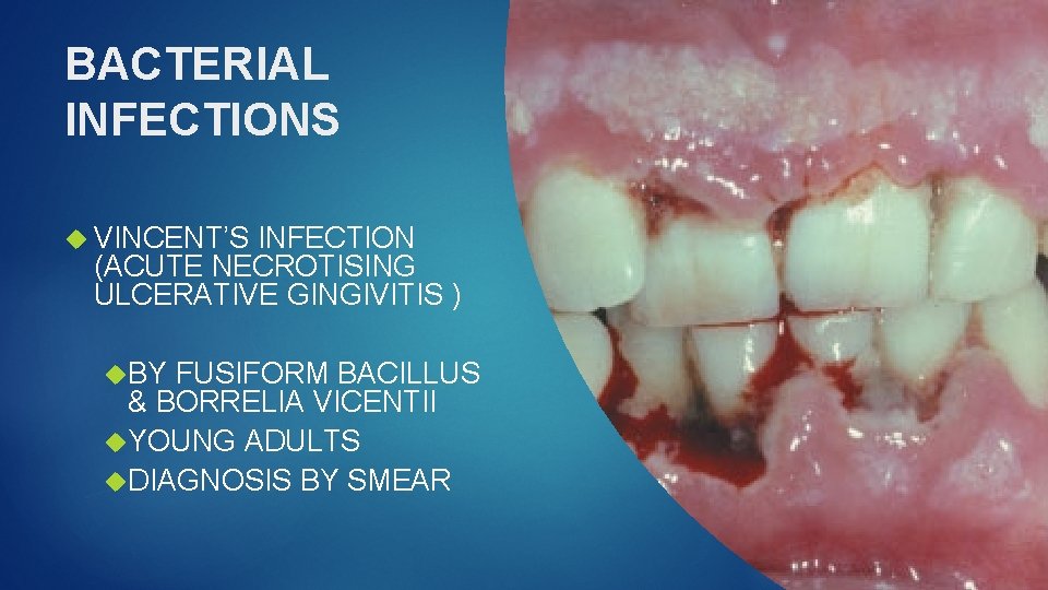 BACTERIAL INFECTIONS VINCENT’S INFECTION (ACUTE NECROTISING ULCERATIVE GINGIVITIS ) BY FUSIFORM BACILLUS & BORRELIA