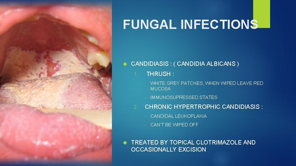 FUNGAL INFECTIONS CANDIDIASIS : ( CANDIDIA ALBICANS ) THRUSH : 1. 2. - WHITE