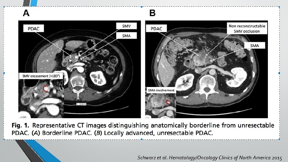 Schwarz et al. Hematology/Oncology Clinics of North America 2015 