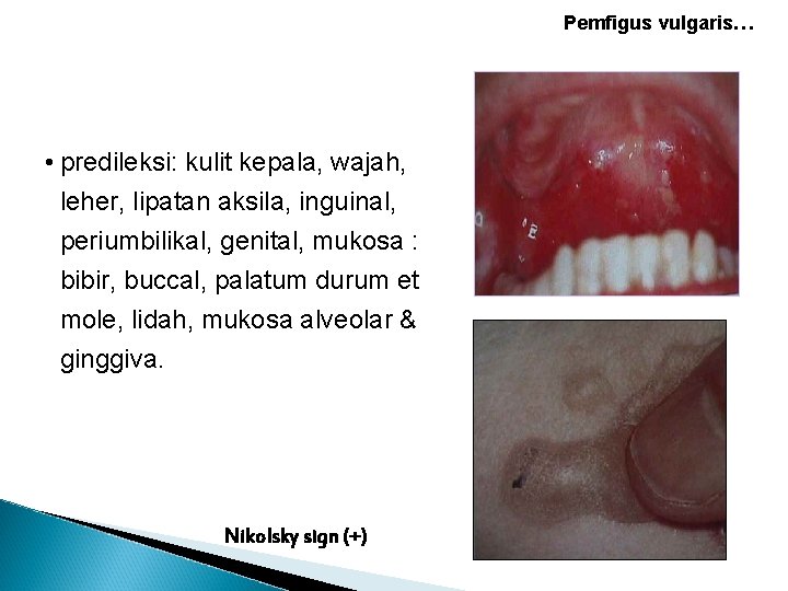 Pemfigus vulgaris… • predileksi: kulit kepala, wajah, leher, lipatan aksila, inguinal, periumbilikal, genital, mukosa Pemfigus vulgaris… • predileksi: kulit kepala, wajah, leher, lipatan aksila, inguinal, periumbilikal, genital, mukosa