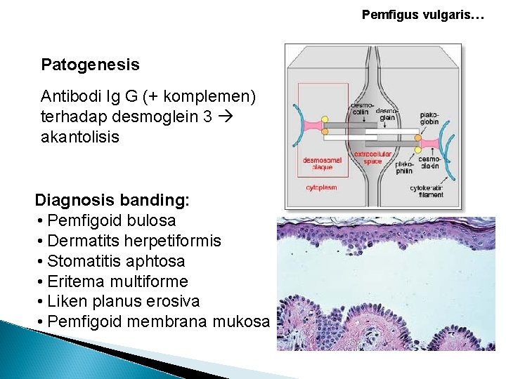 Pemfigus vulgaris… Patogenesis Antibodi Ig G (+ komplemen) terhadap desmoglein 3 akantolisis Diagnosis banding: Pemfigus vulgaris… Patogenesis Antibodi Ig G (+ komplemen) terhadap desmoglein 3 akantolisis Diagnosis banding: