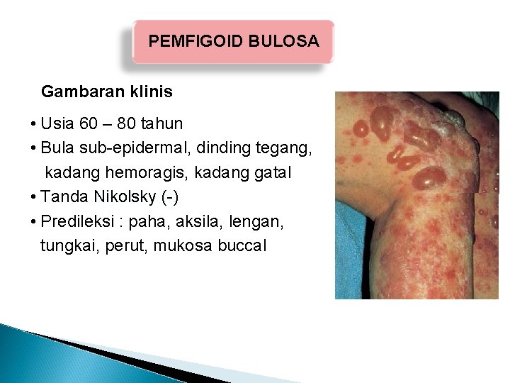 PEMFIGOID BULOSA Gambaran klinis • Usia 60 – 80 tahun • Bula sub-epidermal, dinding PEMFIGOID BULOSA Gambaran klinis • Usia 60 – 80 tahun • Bula sub-epidermal, dinding