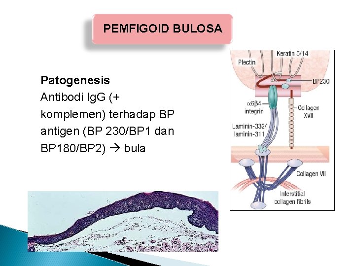 PEMFIGOID BULOSA Patogenesis Antibodi Ig. G (+ komplemen) terhadap BP antigen (BP 230/BP 1 PEMFIGOID BULOSA Patogenesis Antibodi Ig. G (+ komplemen) terhadap BP antigen (BP 230/BP 1