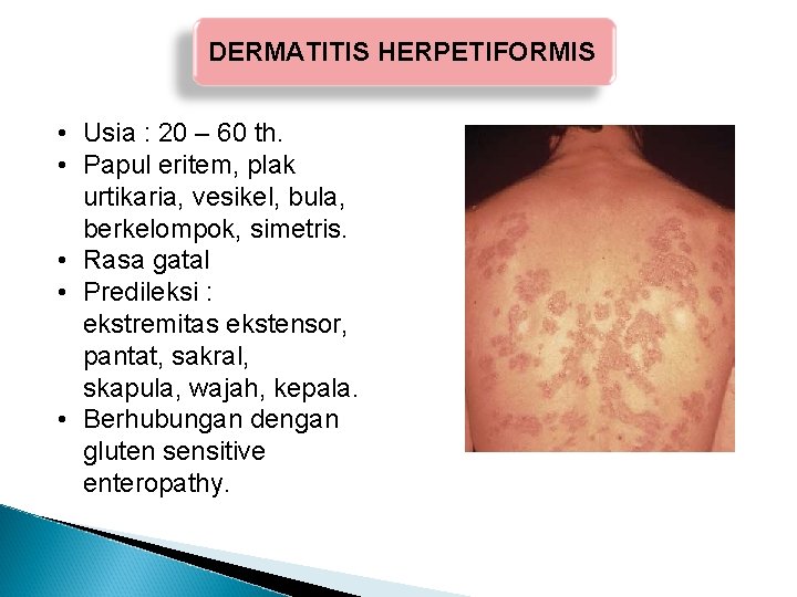 DERMATITIS HERPETIFORMIS • Usia : 20 – 60 th. • Papul eritem, plak urtikaria, DERMATITIS HERPETIFORMIS • Usia : 20 – 60 th. • Papul eritem, plak urtikaria,