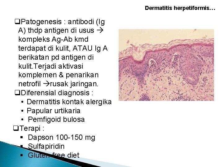 Dermatitis herpetiformis… q. Patogenesis : antibodi (Ig A) thdp antigen di usus kompleks Ag-Ab Dermatitis herpetiformis… q. Patogenesis : antibodi (Ig A) thdp antigen di usus kompleks Ag-Ab