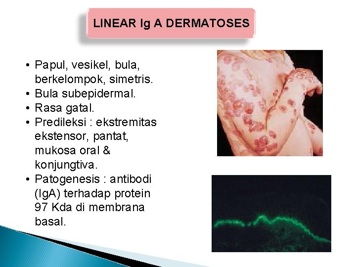 LINEAR Ig A DERMATOSES • Papul, vesikel, bula, berkelompok, simetris. • Bula subepidermal. • LINEAR Ig A DERMATOSES • Papul, vesikel, bula, berkelompok, simetris. • Bula subepidermal. •