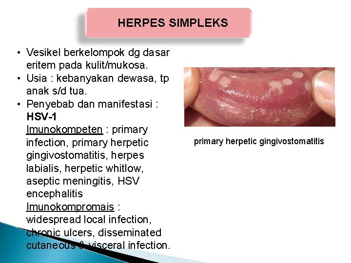 HERPES SIMPLEKS • Vesikel berkelompok dg dasar eritem pada kulit/mukosa. • Usia : kebanyakan HERPES SIMPLEKS • Vesikel berkelompok dg dasar eritem pada kulit/mukosa. • Usia : kebanyakan