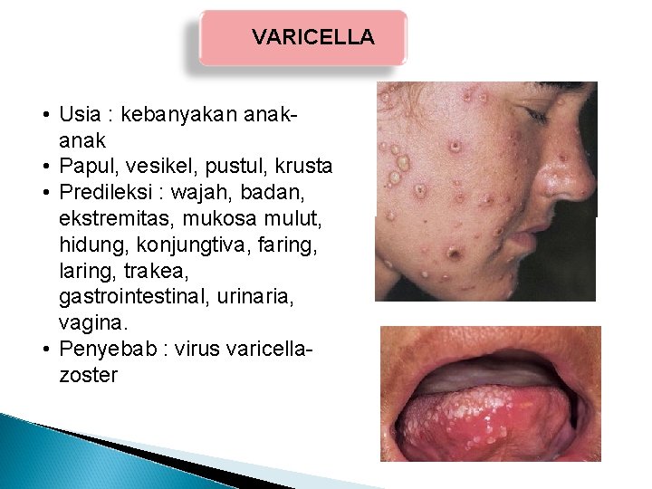 VARICELLA • Usia : kebanyakan anak • Papul, vesikel, pustul, krusta • Predileksi : VARICELLA • Usia : kebanyakan anak • Papul, vesikel, pustul, krusta • Predileksi :