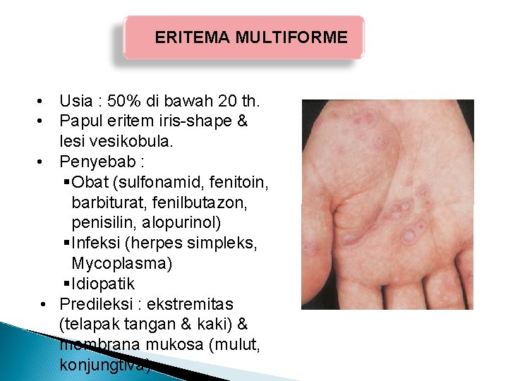ERITEMA MULTIFORME • Usia : 50% di bawah 20 th. • Papul eritem iris-shape ERITEMA MULTIFORME • Usia : 50% di bawah 20 th. • Papul eritem iris-shape