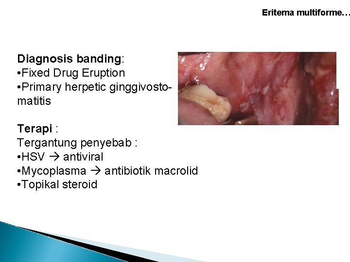Eritema multiforme… Diagnosis banding: • Fixed Drug Eruption • Primary herpetic ginggivostomatitis Terapi : Eritema multiforme… Diagnosis banding: • Fixed Drug Eruption • Primary herpetic ginggivostomatitis Terapi :