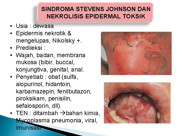 SINDROMA STEVENS JOHNSON DAN NEKROLISIS EPIDERMAL TOKSIK • Usia : dewasa • Epidermis nekrotik SINDROMA STEVENS JOHNSON DAN NEKROLISIS EPIDERMAL TOKSIK • Usia : dewasa • Epidermis nekrotik